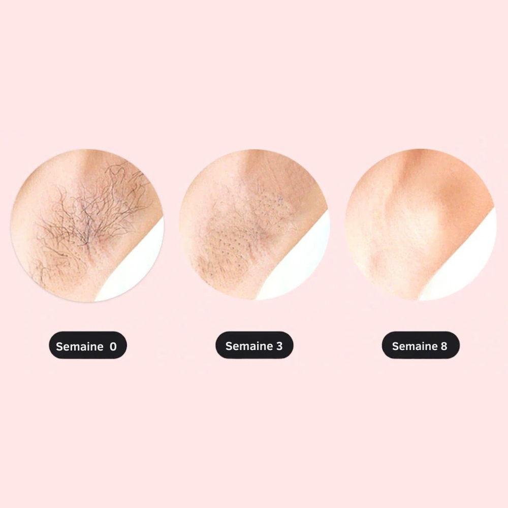 SmoothTouch IPL™ | Épilation permanente – technologie douce pour une peau lisse toute l'année