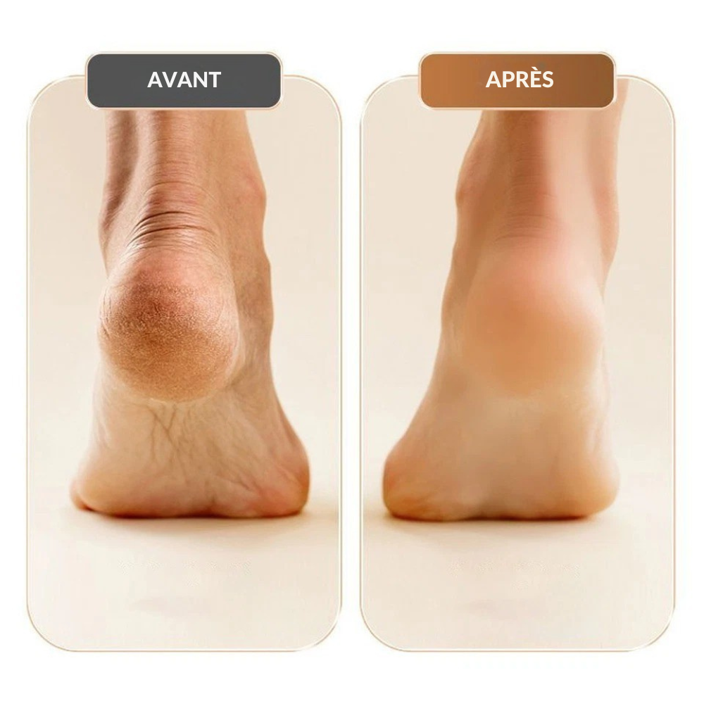 SilkSole™ | Élimination électrique de la peau dure pour des pieds lisses