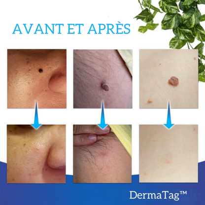 DermaTag™ | Retrouver une peau lisse et dire adieu aux acrochordons