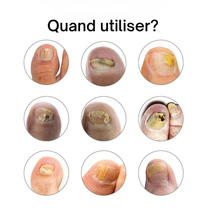 NailCure™ | Traitement ultime des ongles pour des ongles sains et beaux