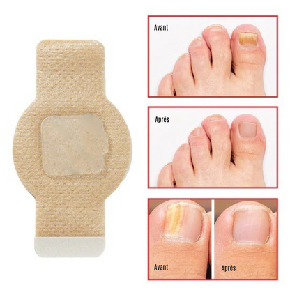 NailRepair™ | Pansement contre les mycoses des ongles