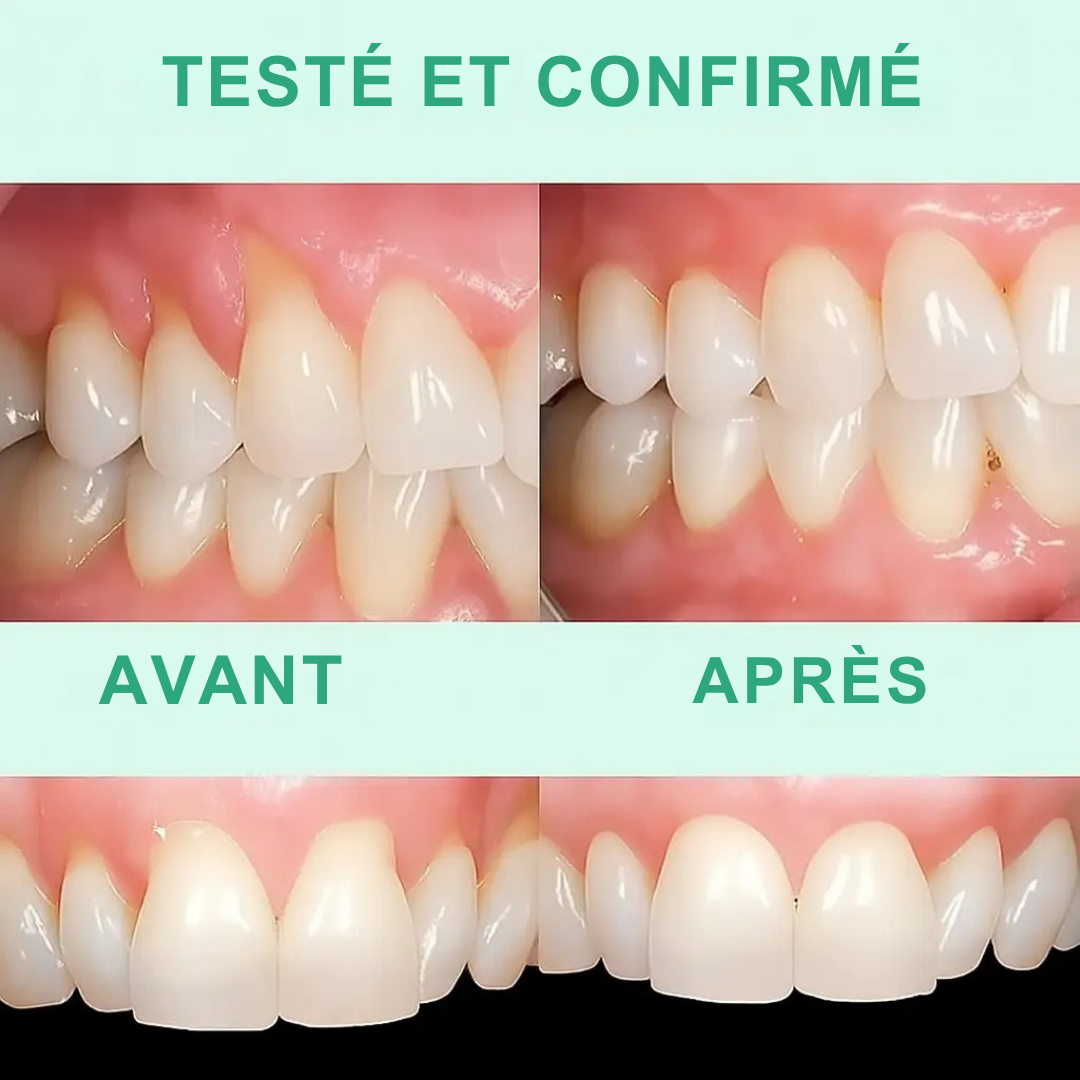 GumVital™ | Amélioration visible des gencives à 93% !