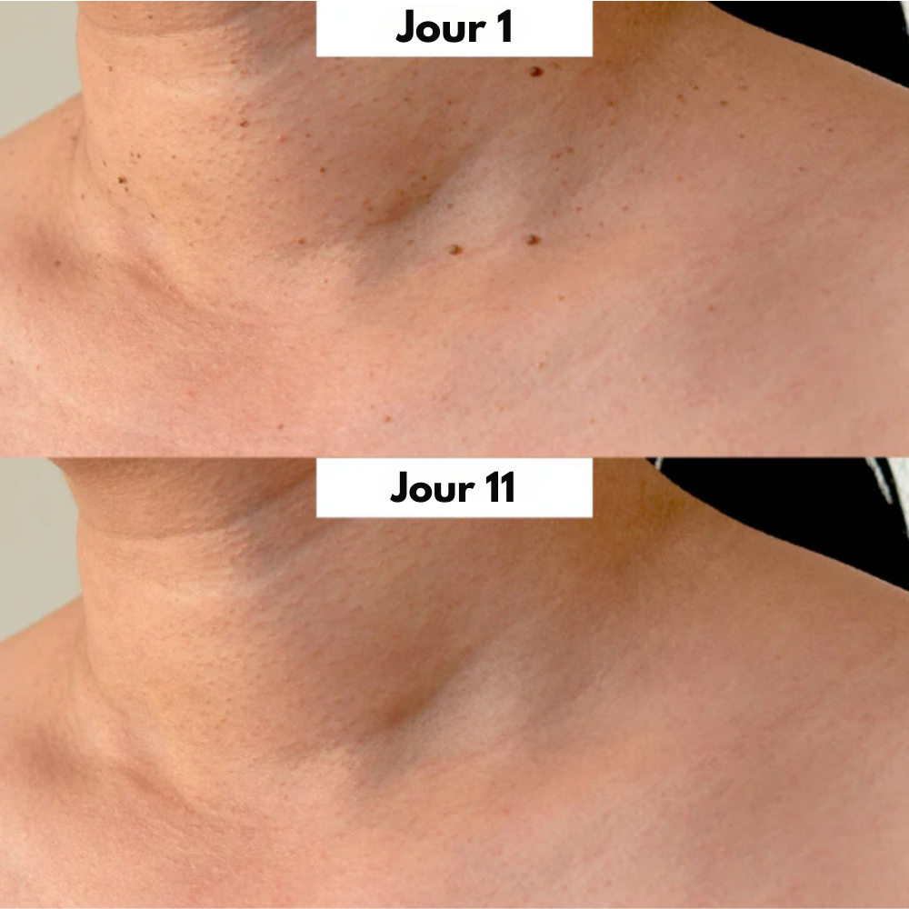 DermoPen™ Kit | Éliminez facilement et en douceur les marques de peau – chez vous