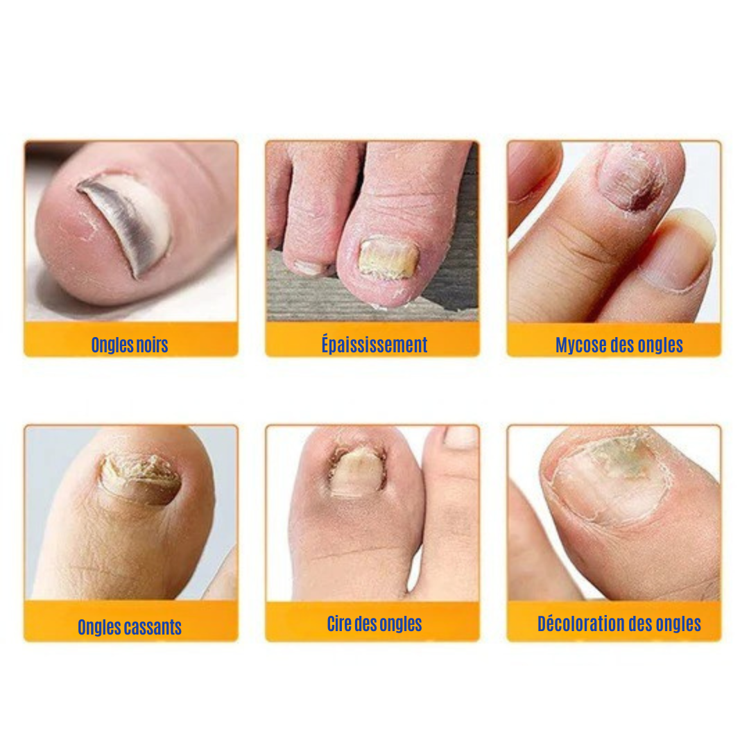 NailRepair™ | Pansement contre les mycoses des ongles