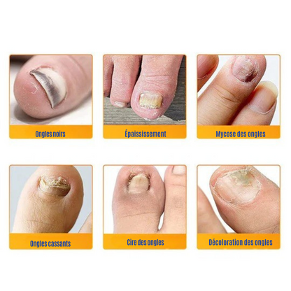 NailRepair™ | Pansement contre les mycoses des ongles