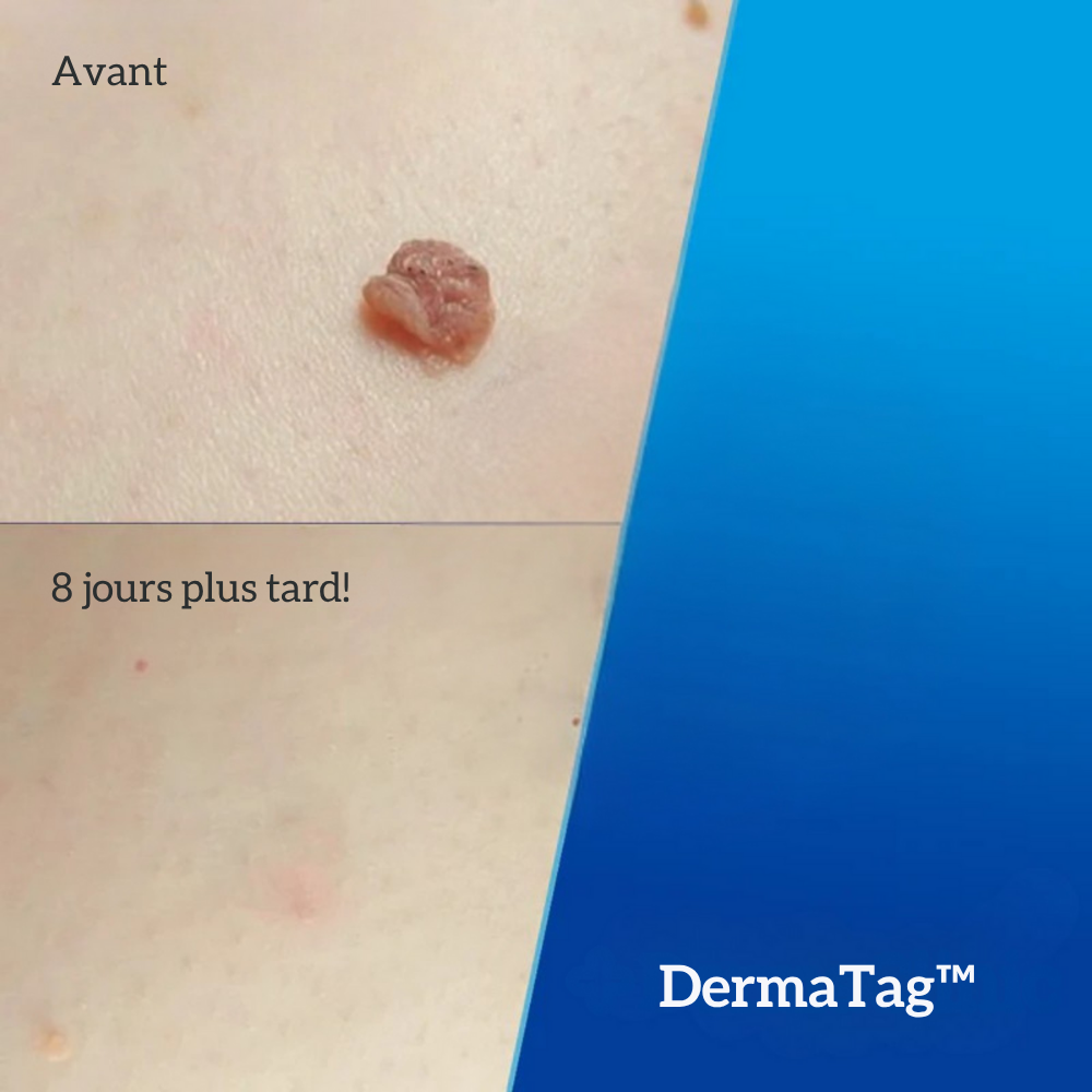 DermaTag™ | Retrouver une peau lisse et dire adieu aux acrochordons