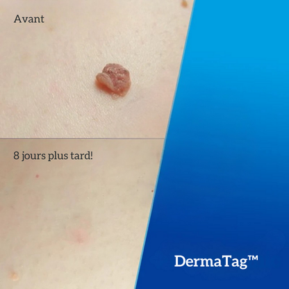 DermaTag™ | Retrouver une peau lisse et dire adieu aux acrochordons