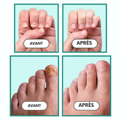 NailCure™ | Traitement ultime des ongles pour des ongles sains et beaux