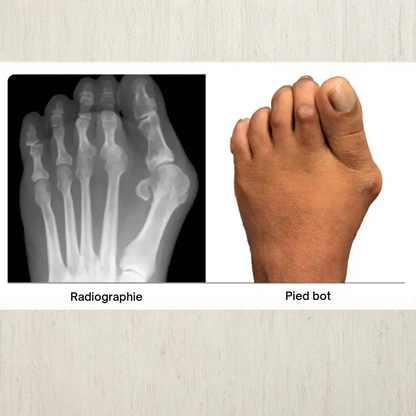 AlignOrteil™ | Rétablissez l'équilibre naturel de vos pieds sans intervention