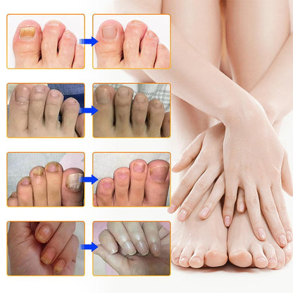 NailRepair™ | Pansement contre les mycoses des ongles